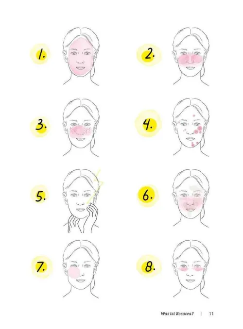 Rosacea*Trias Best